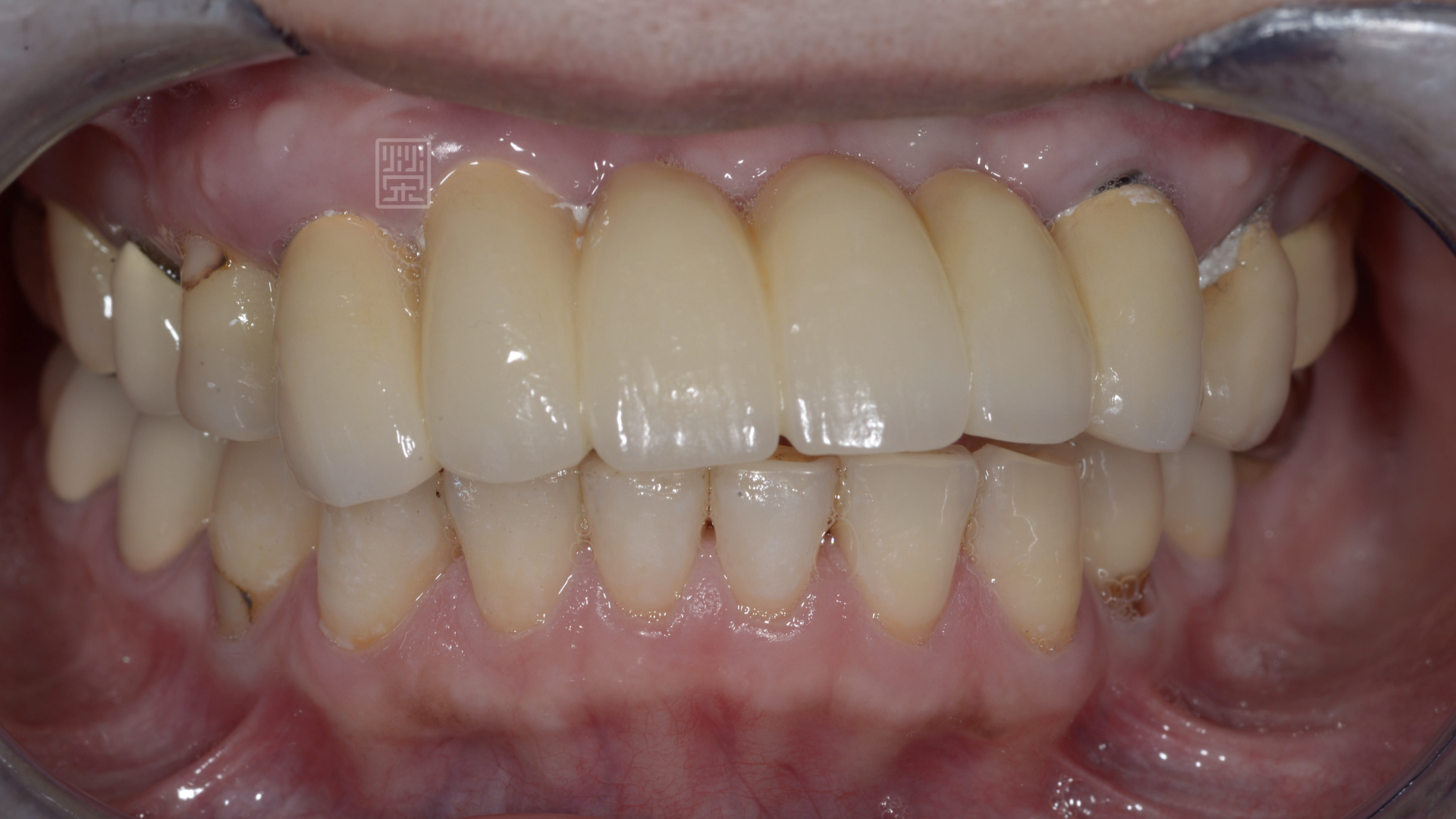 口內檢查發現，牙齒歪斜，咬合開咬，無法有正常的咀嚼功能