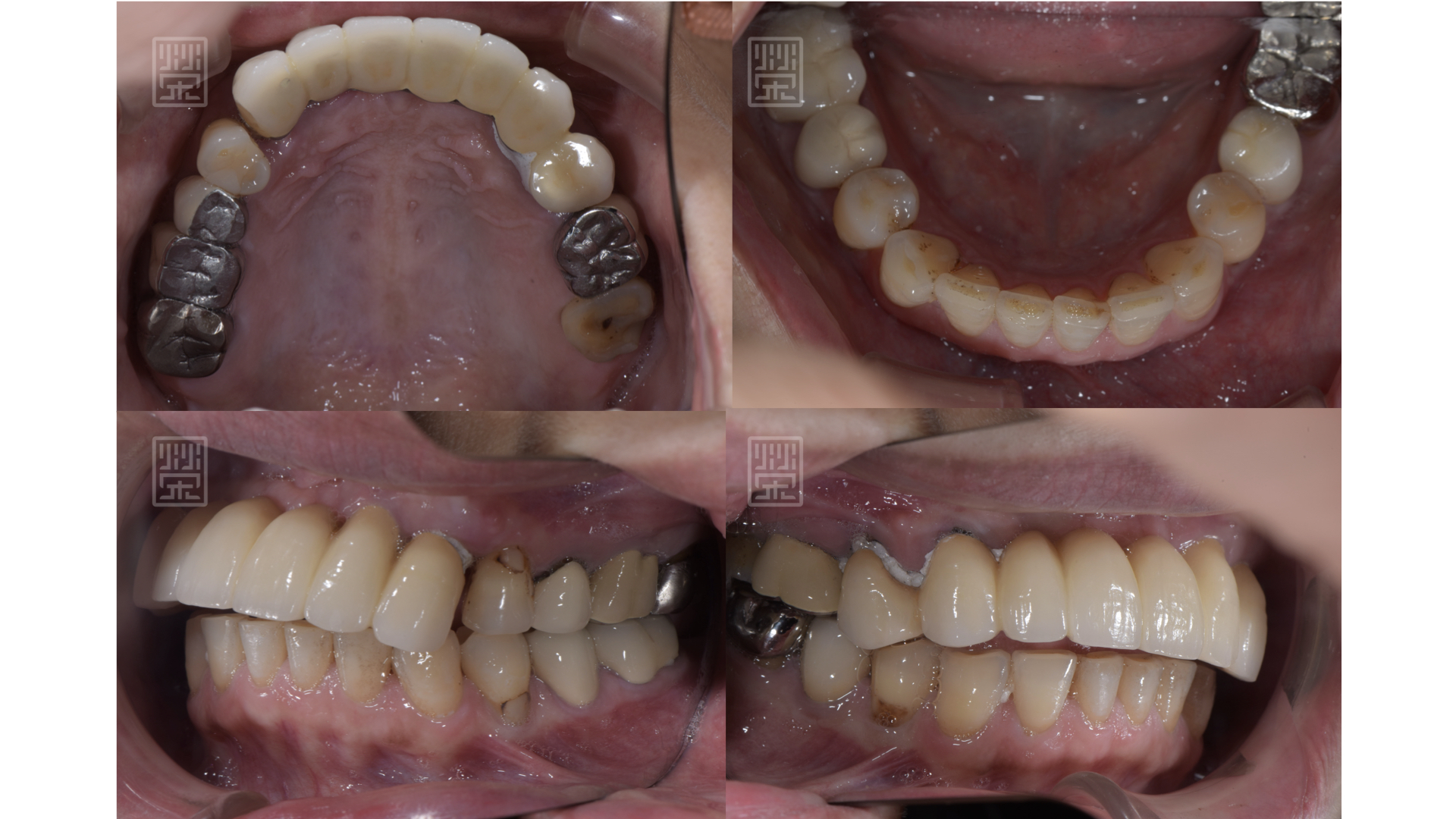 口內照片顯示，假牙黏膠未脫落、邊緣不秘貼，無法正常咀嚼及說話