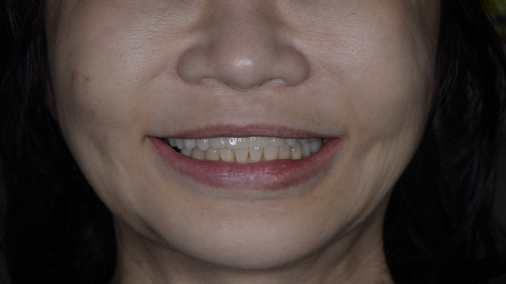 更換臨時假牙後，恢復外觀與功能