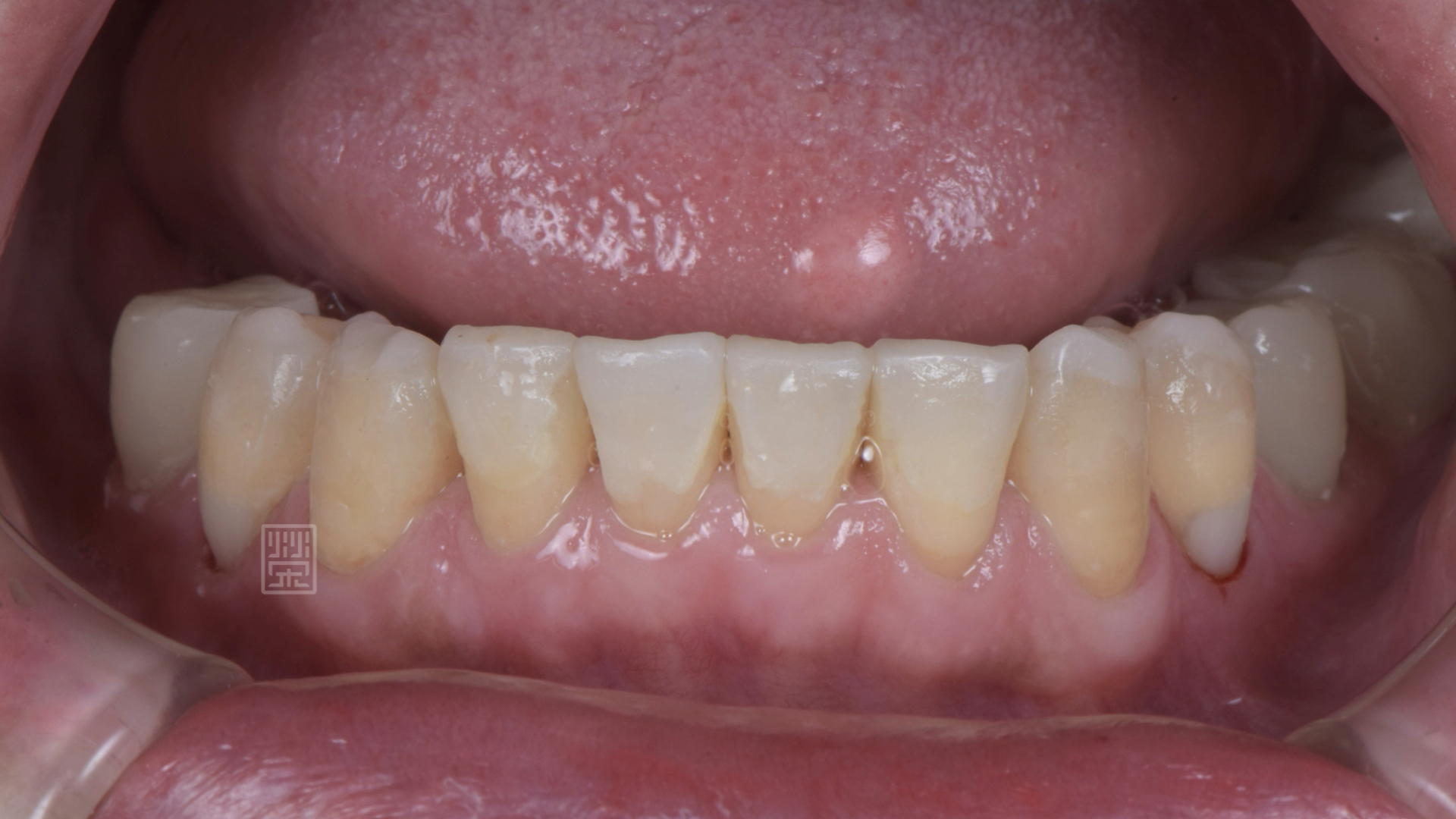 預計增加上顎門牙長度，先將下顎門牙用樹脂恢復原本型態，將貼片的空間先保存起來