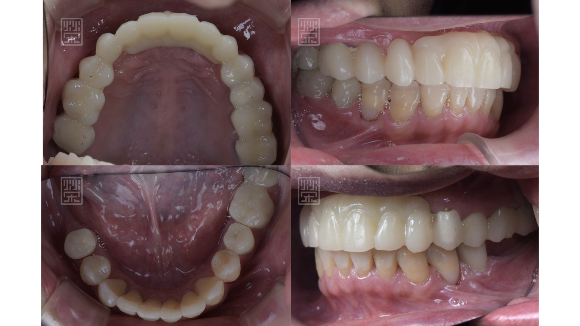 更換臨時假牙後，恢復外觀與功能