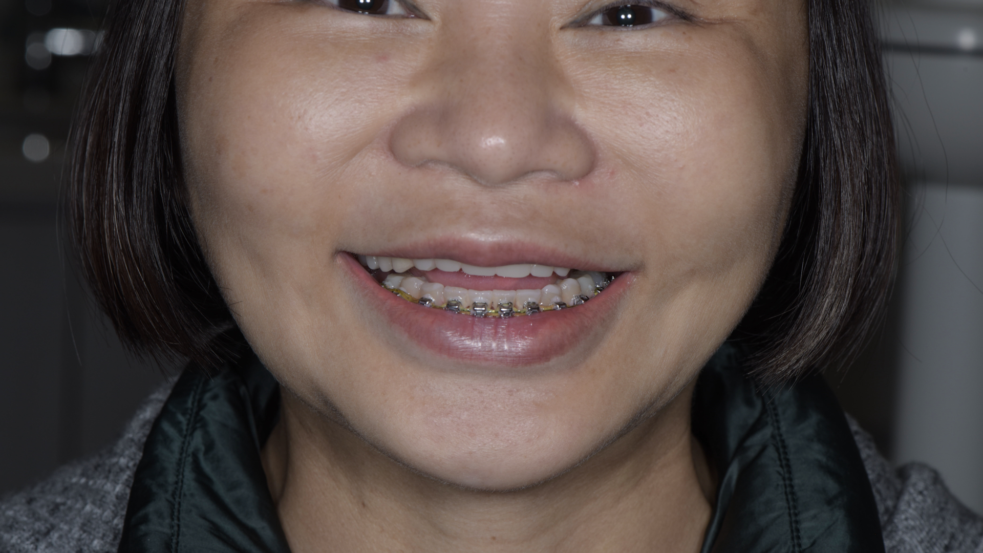 藉由矯正，將下顎們牙齒軸拉正