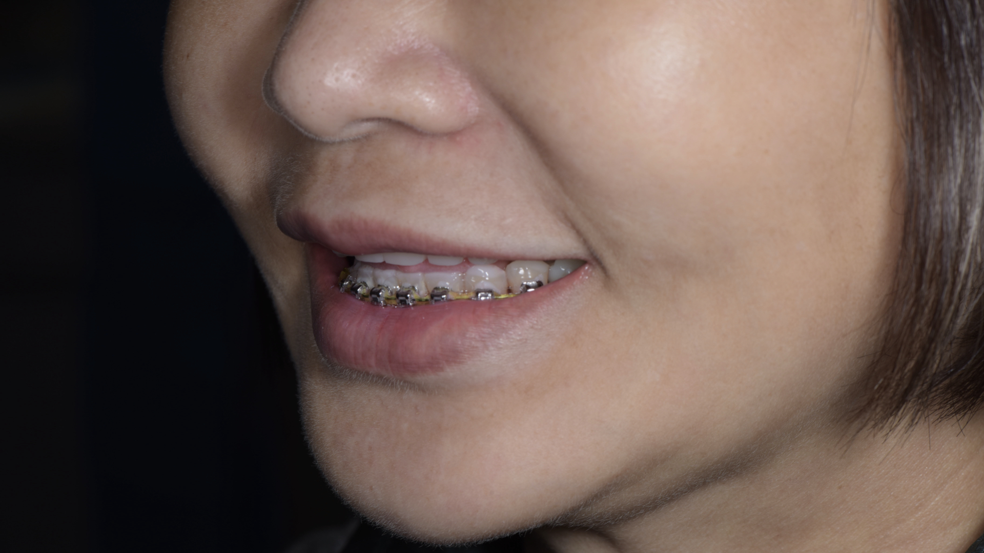 藉由矯正，將下顎們牙齒軸拉正