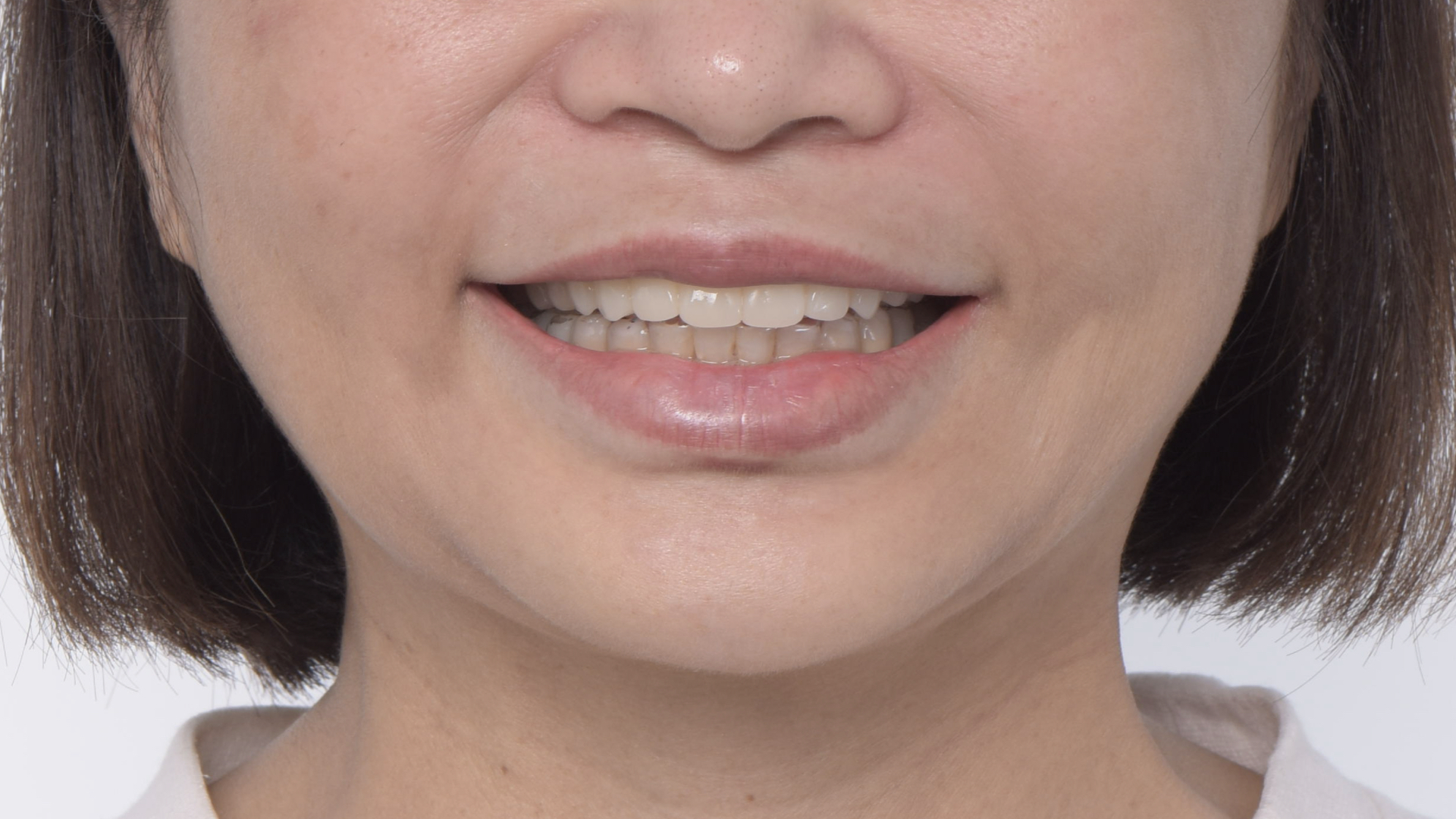 矯正後，再將門牙拉長，達到理想的牙齒的長度