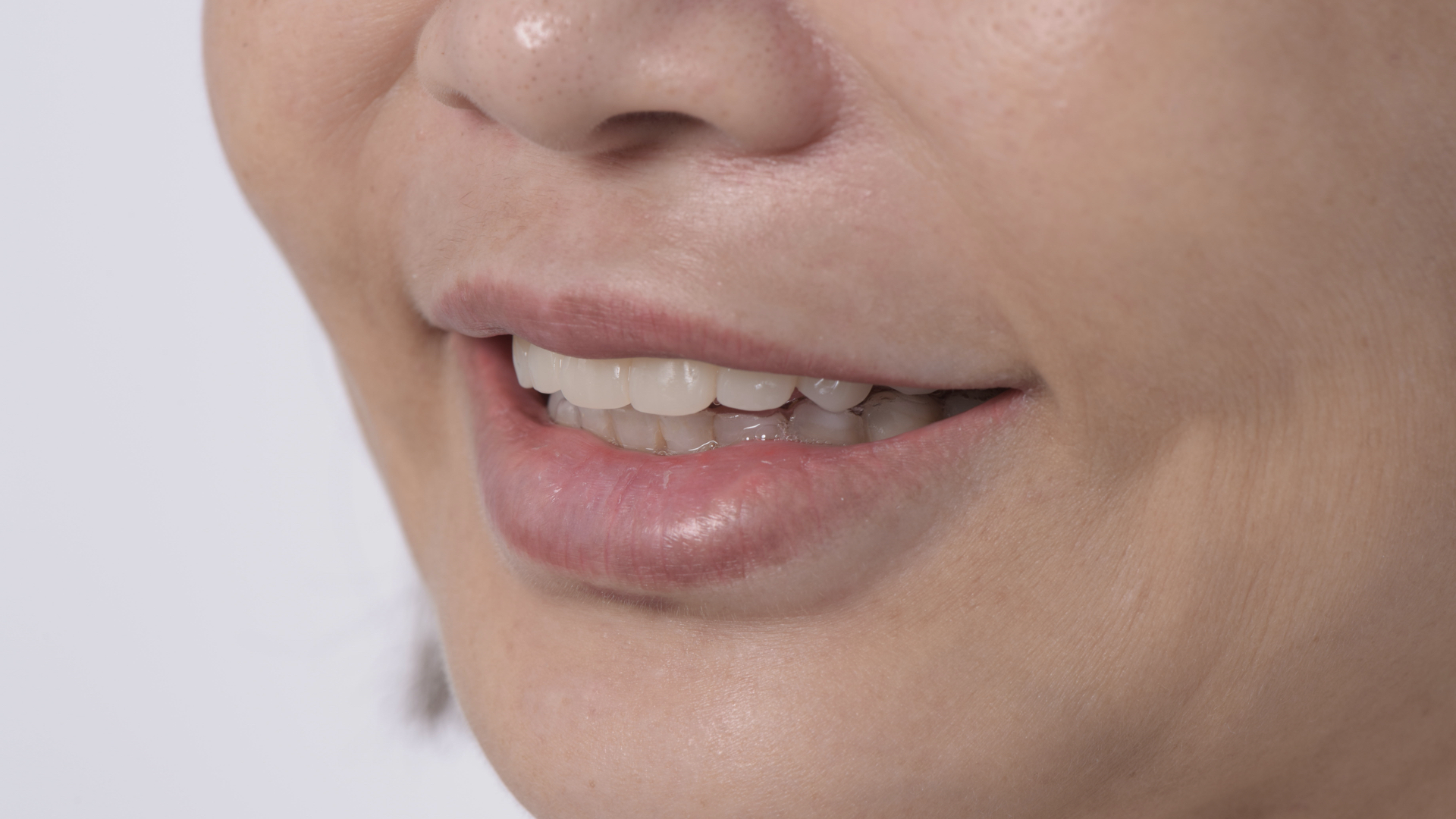 矯正後，再將門牙拉長，達到理想的牙齒的長度