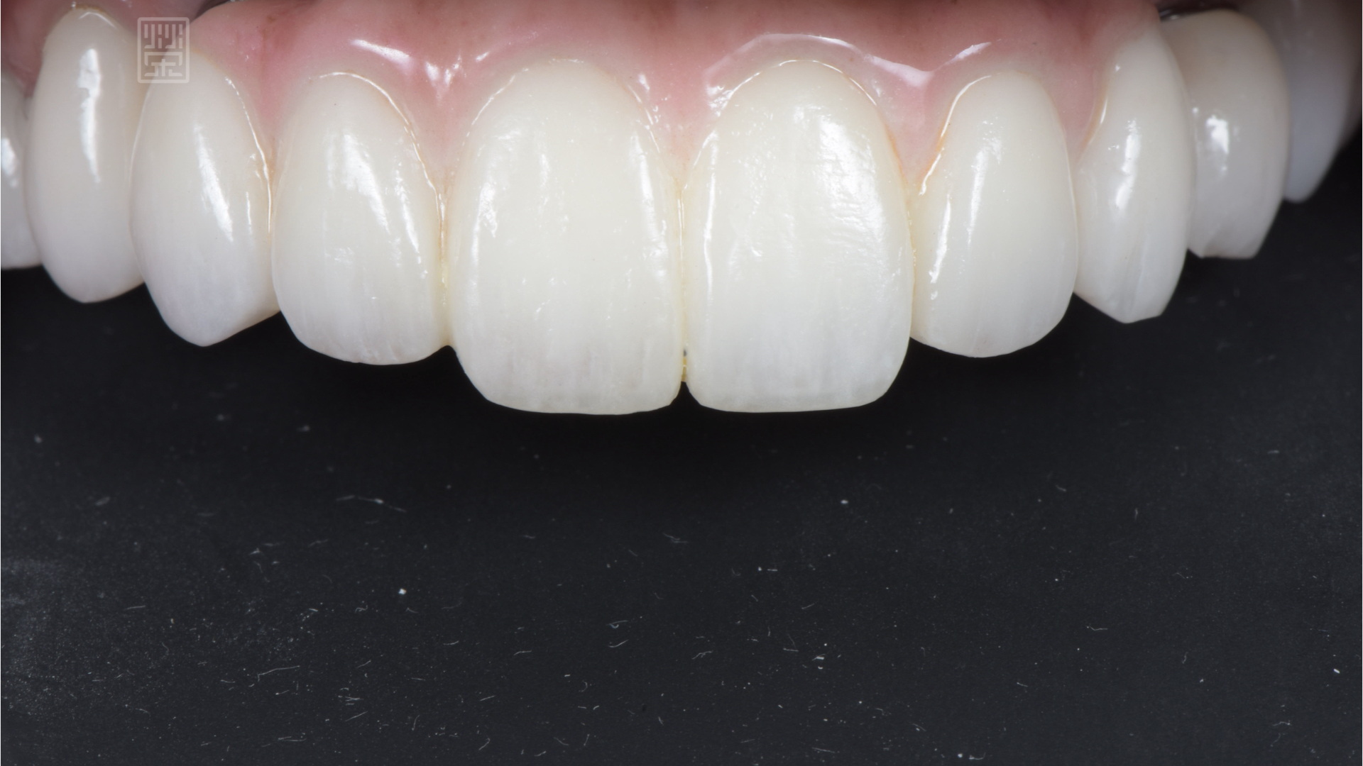 用全瓷牙橋與牙齦色陶瓷，恢復牙齒外觀與型態