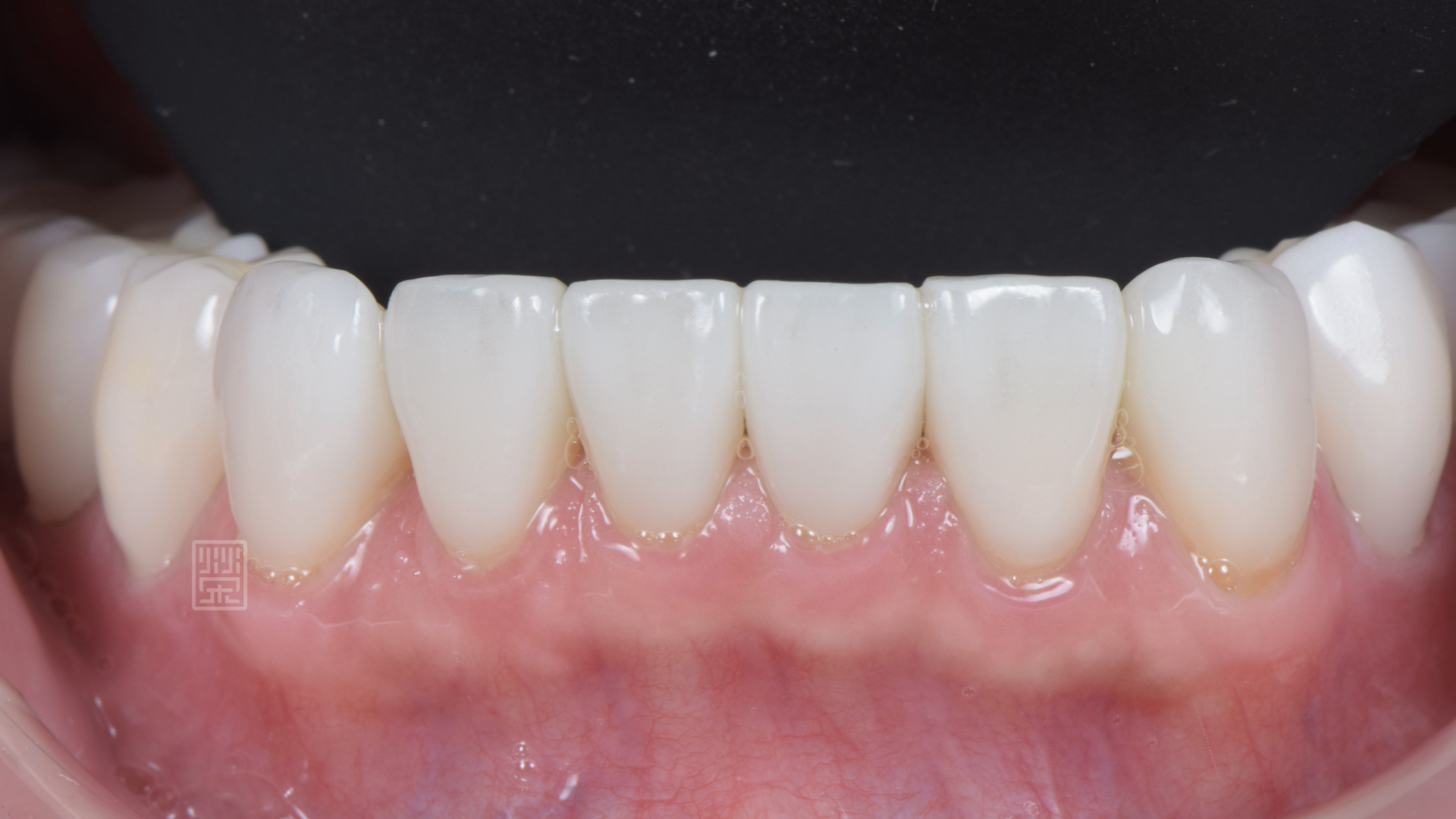 玻璃陶瓷貼片改變下顎門齒顏色與型態