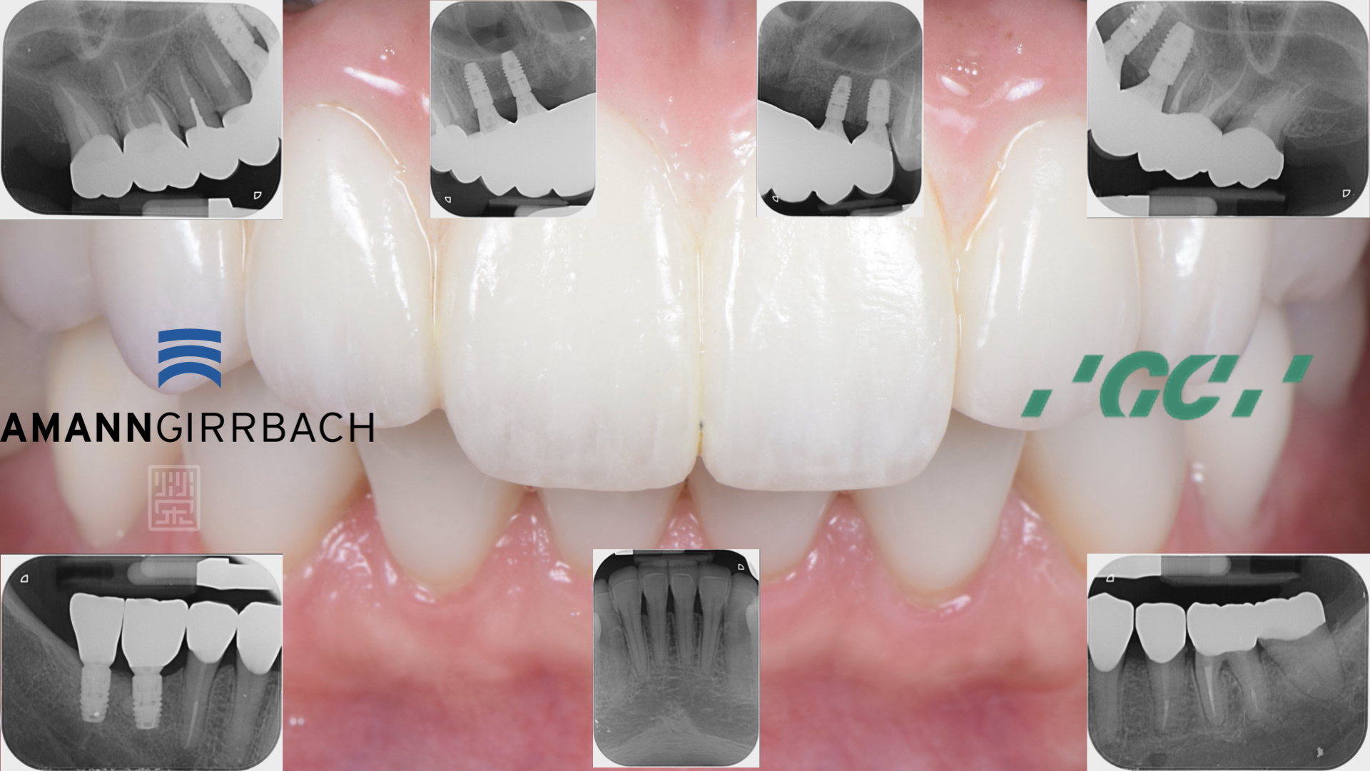 Ｘ光檢查下，全瓷贋復物與牙齒秘貼性良好，讓清潔容易好維持