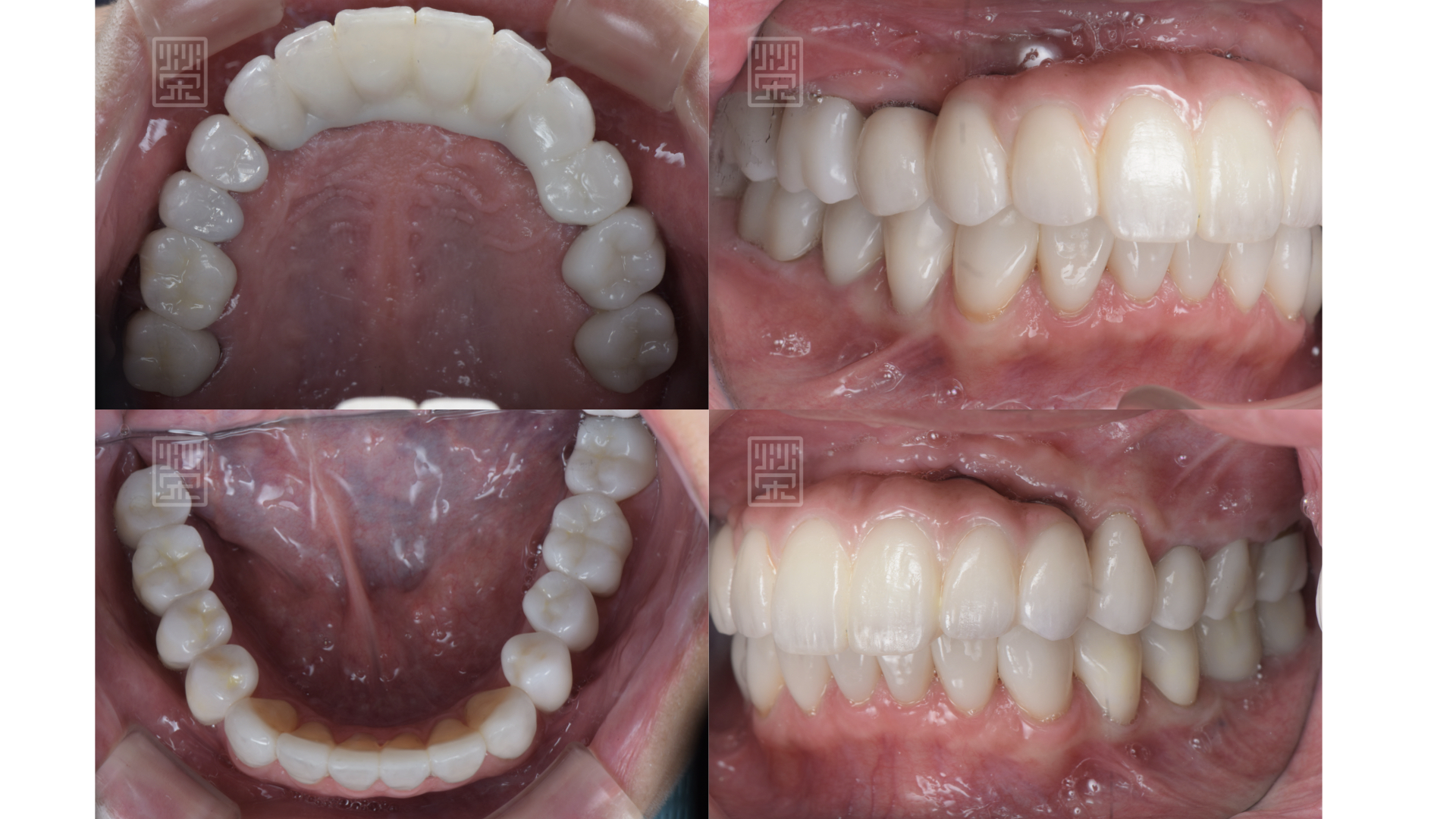 全瓷贋復物完成