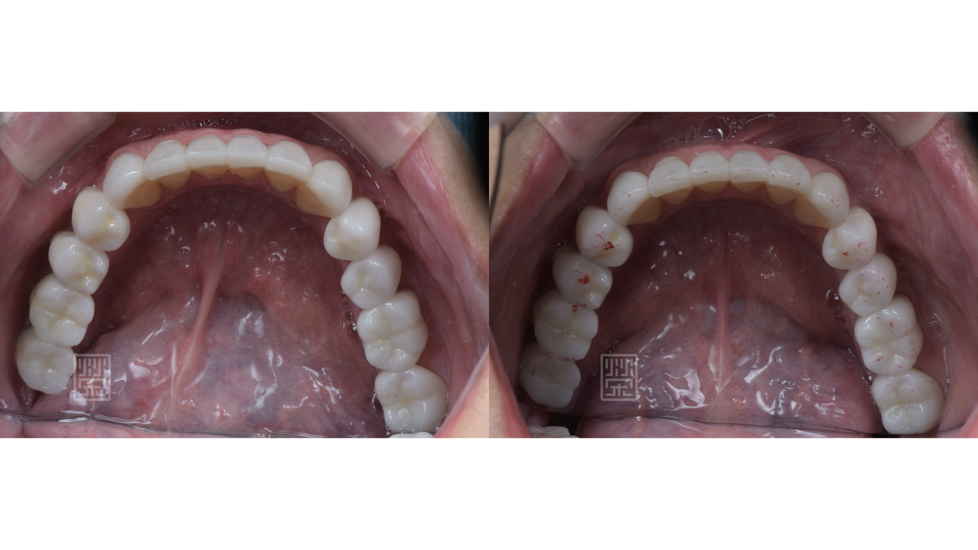 適當的咬合分配