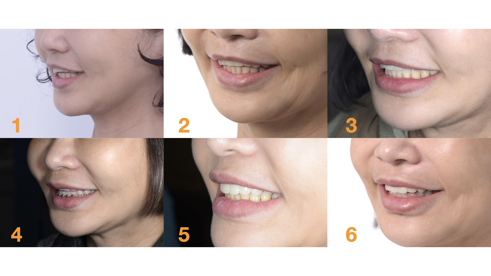 藉由臨時假牙、矯正、更新臨時假牙，讓型態、長度、唇形充分瞭解與溝通