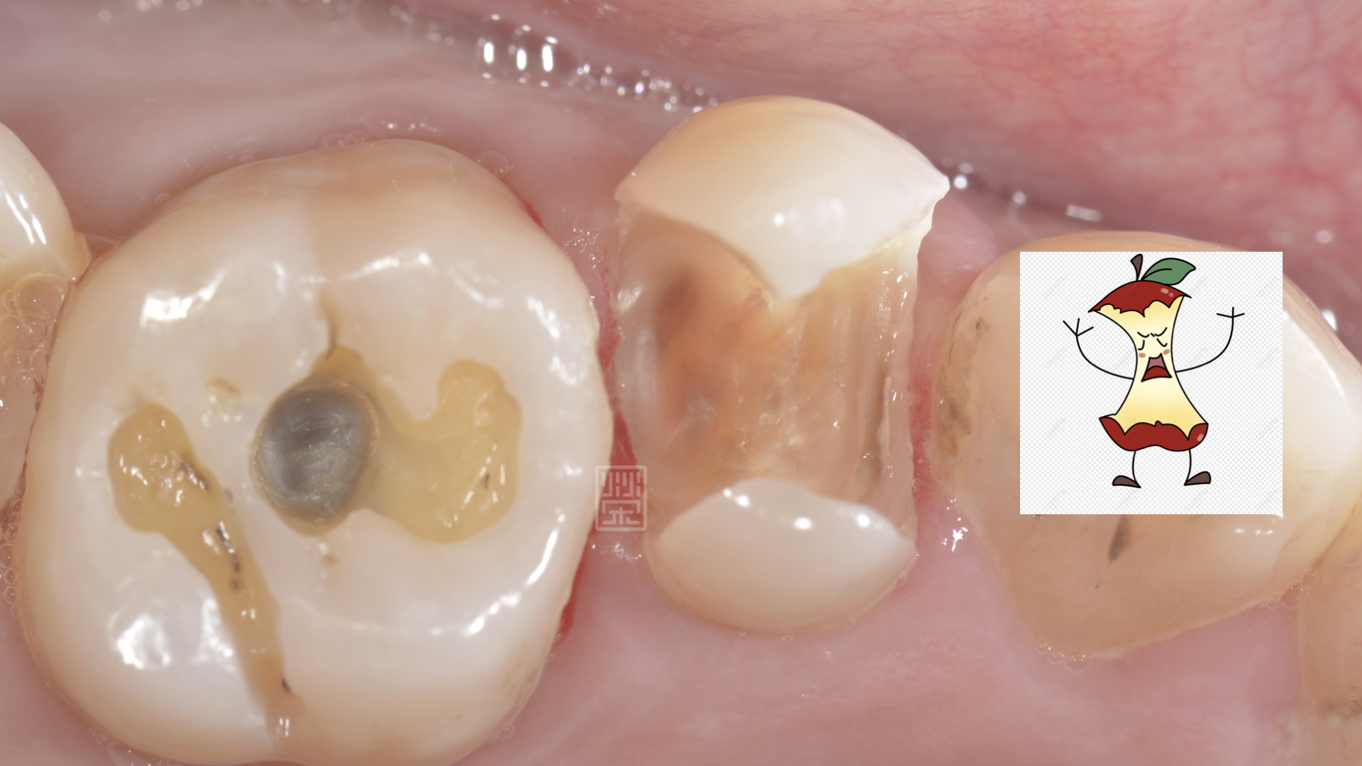 蛀牙拿乾淨後，很像蘋果卡通圖被啃一圈的樣子