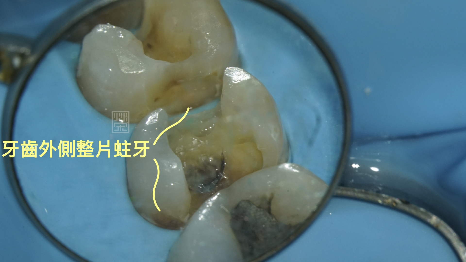 除了內部蛀牙外，外側也因清潔不當所造成的蛀牙
