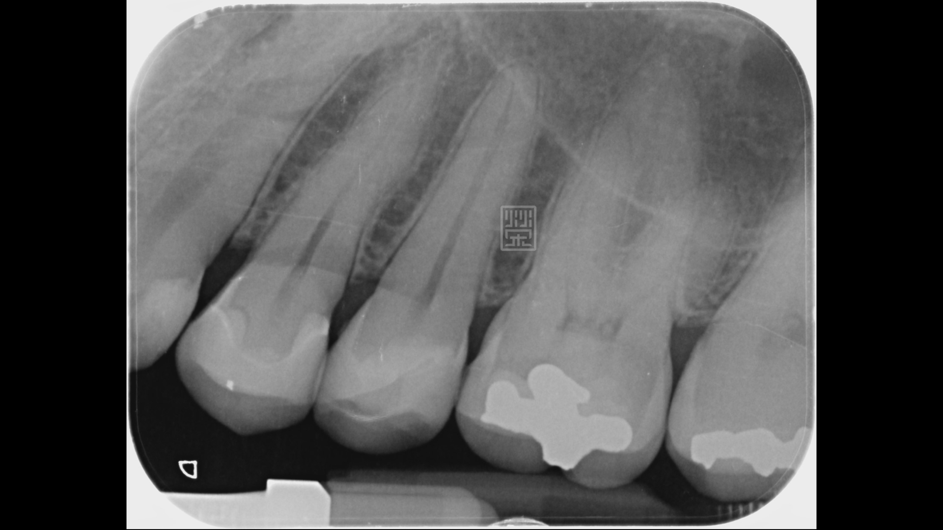 Ｘ光檢查下，牙髓維持健康狀態