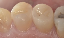 牙齒咬起來怪怪的，原來是邊緣裂了一個縫，沒想到裡面牙齒蛀這麼大------全瓷嵌體修復