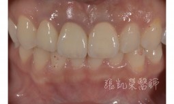假牙邊緣牙齦變黑---全瓷冠