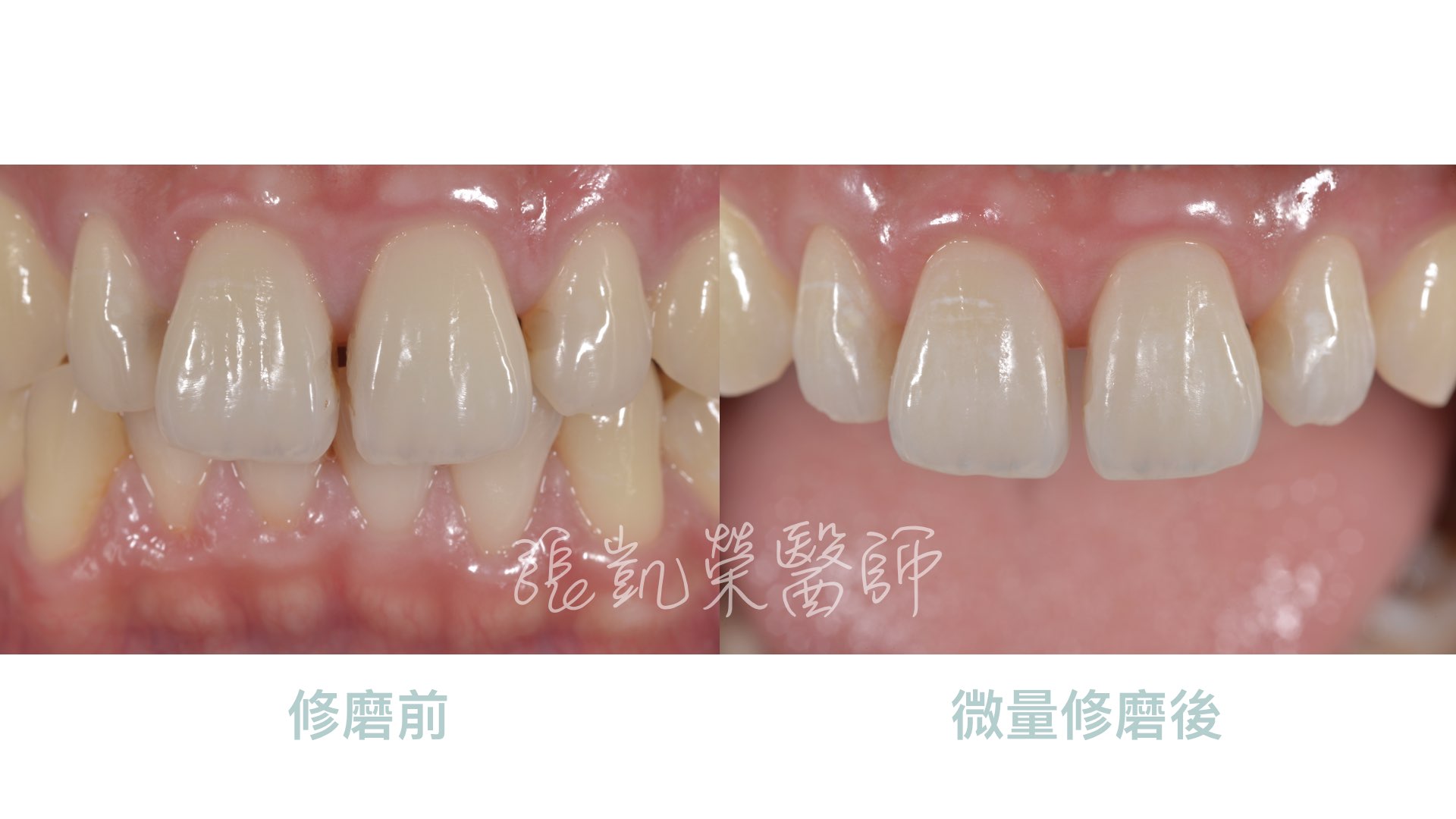 幾乎不傷害牙齒的修磨