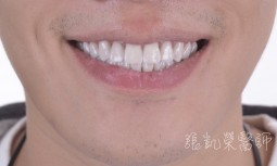 牙齒很黃多顆嚴重蛀牙---全瓷冠併全瓷貼片