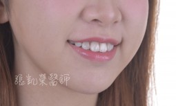 牙齒多處樹脂填補變色---全瓷貼片合併美白治療