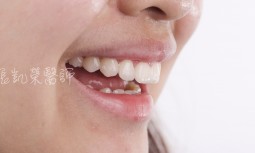 多處齒縫牙齒偏小---全瓷貼片修復