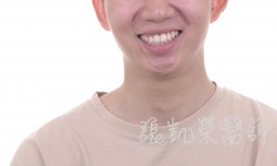 牙齒美白---矯正後牙齒亮白處理