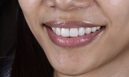 牙冠邊緣變黑，門牙無微笑曲線---全瓷冠全瓷貼片合併全口美白