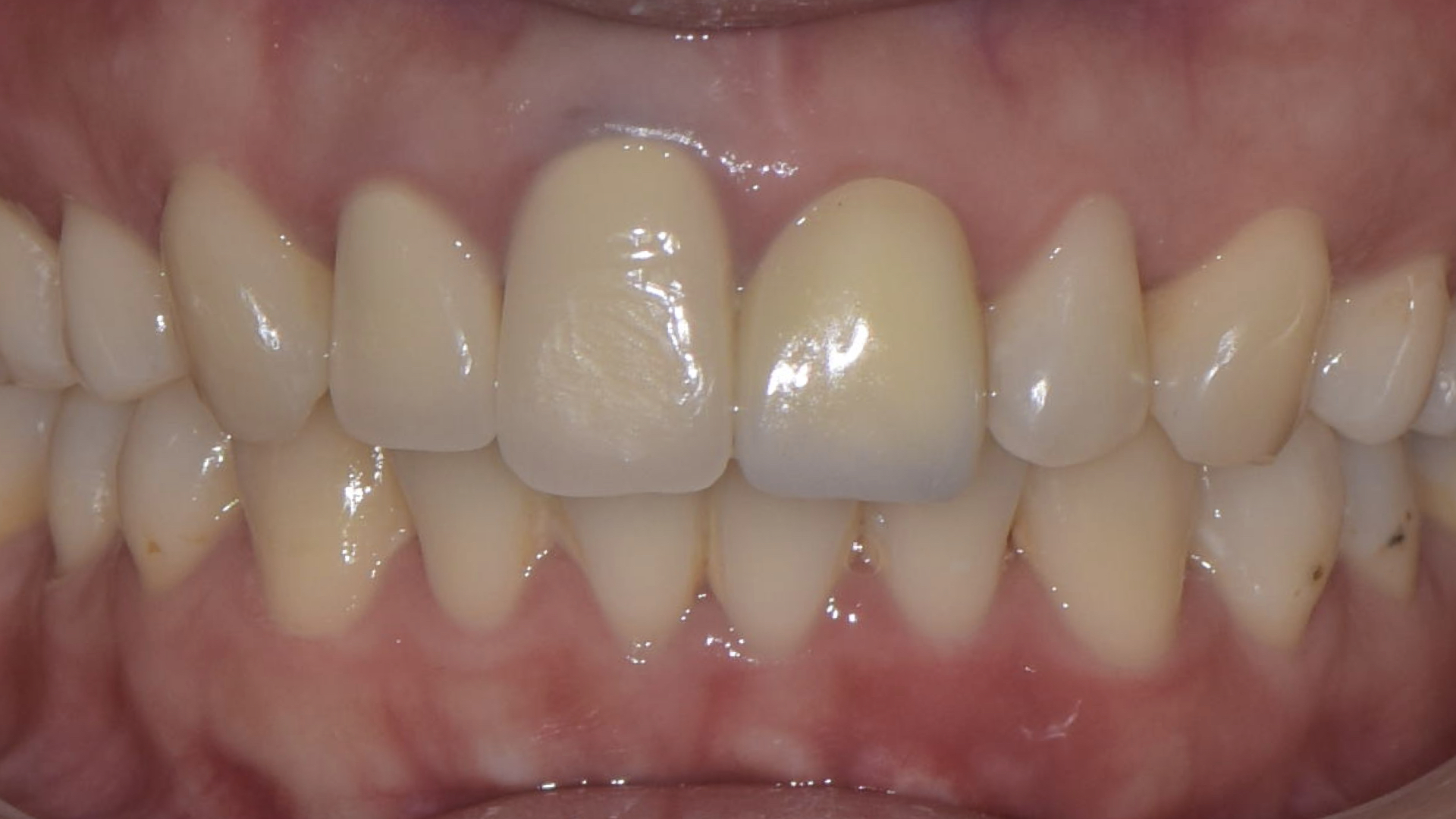 牙齦萎縮，假牙過長