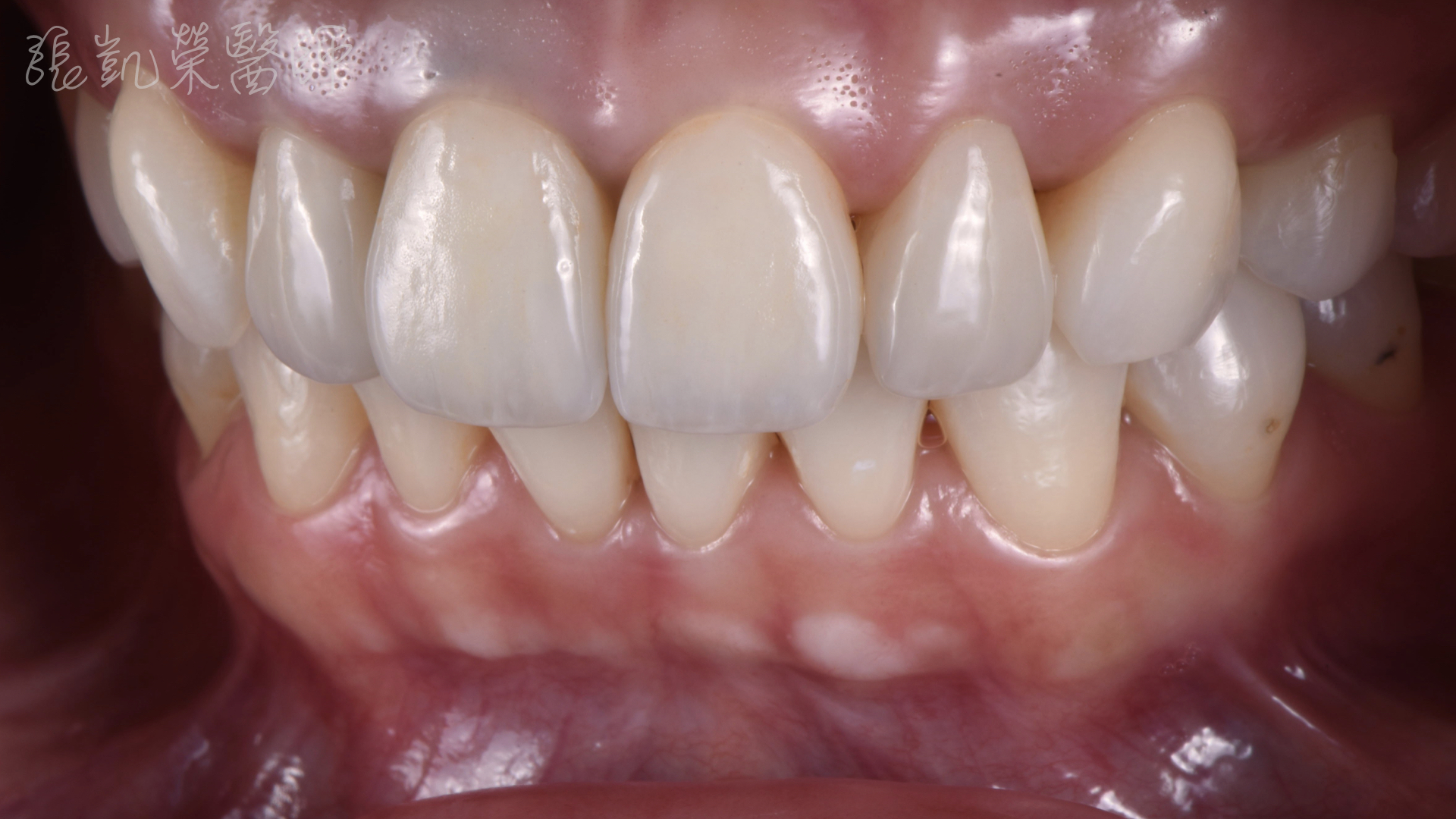 網站照片.005全瓷冠貼片完成