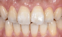 牙齒斷裂怎麼辦？---顯微貼片微創修復