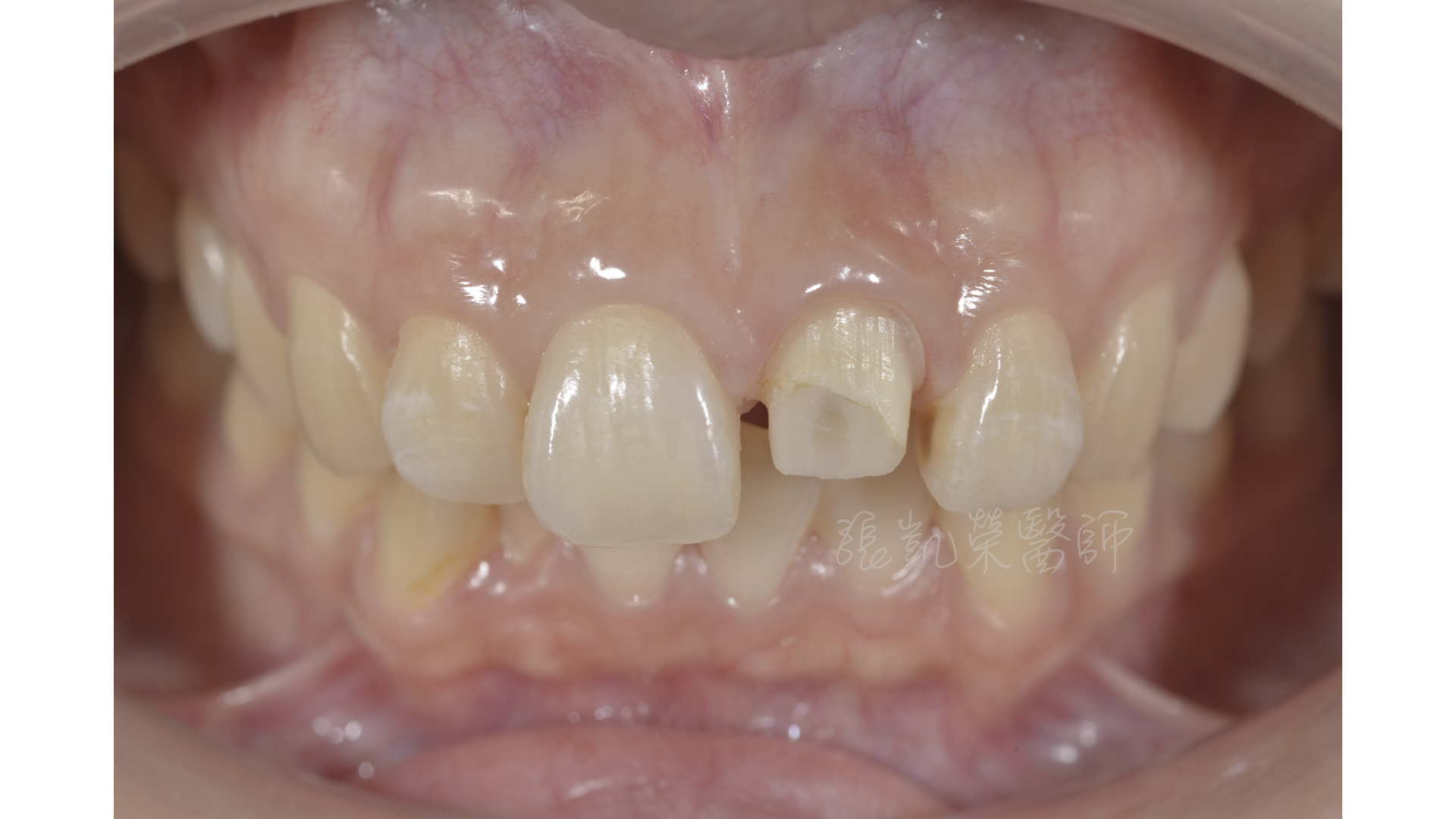 齒內美白與碳纖維柱釘治療後