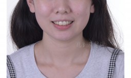 我根管治療後的牙齒變黑變黃了之二---全瓷冠、齒內美白治療