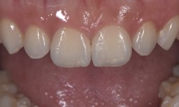 我的門牙有縫，能夠傷害牙齒最小的狀況下，把縫關起來嗎---顯微貼片治療