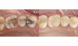 醫師，我的牙齒破掉了怎麼辦？------全瓷嵌體修復大範圍蛀牙