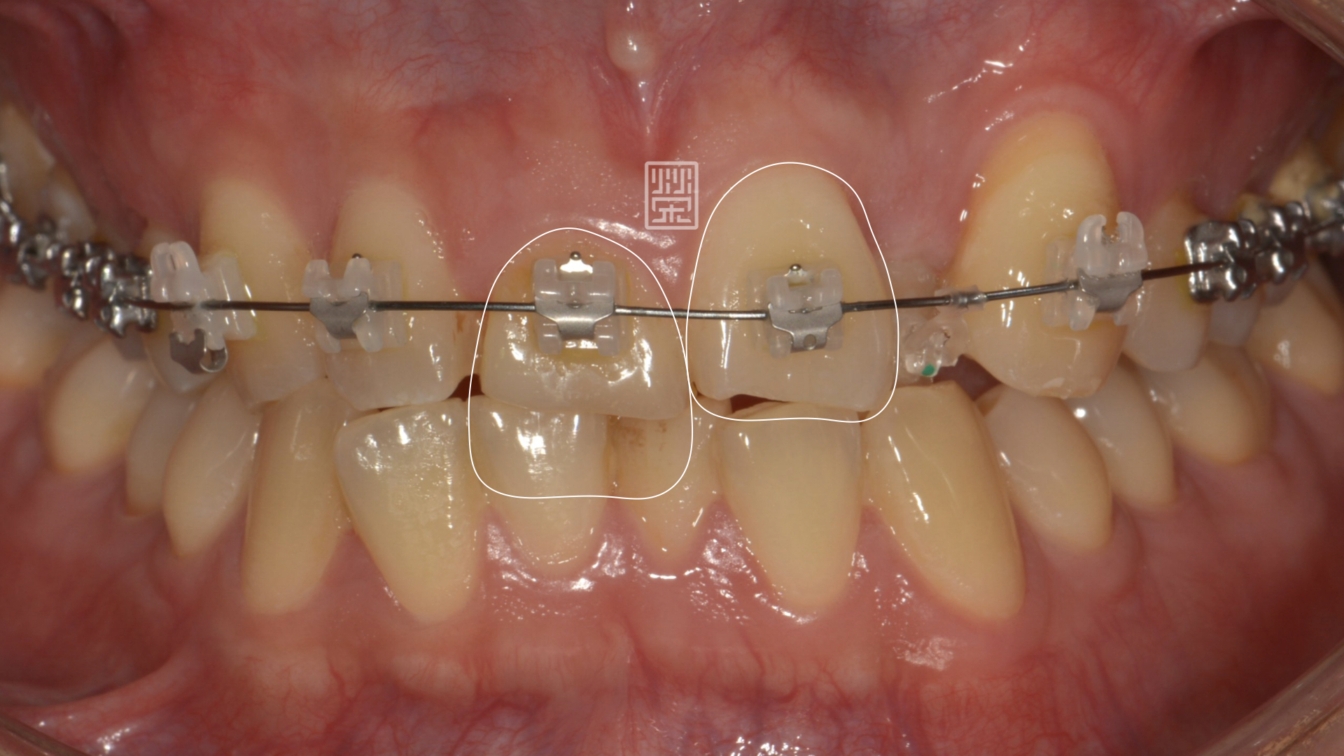 矯正時評估正常牙齒範圍，並用樹脂暫時修復