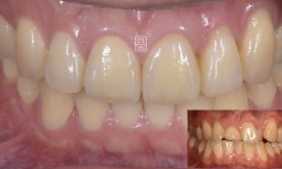 牙齒不整齊且牙齒磨短了---矯正既全瓷冠與貼片修復
