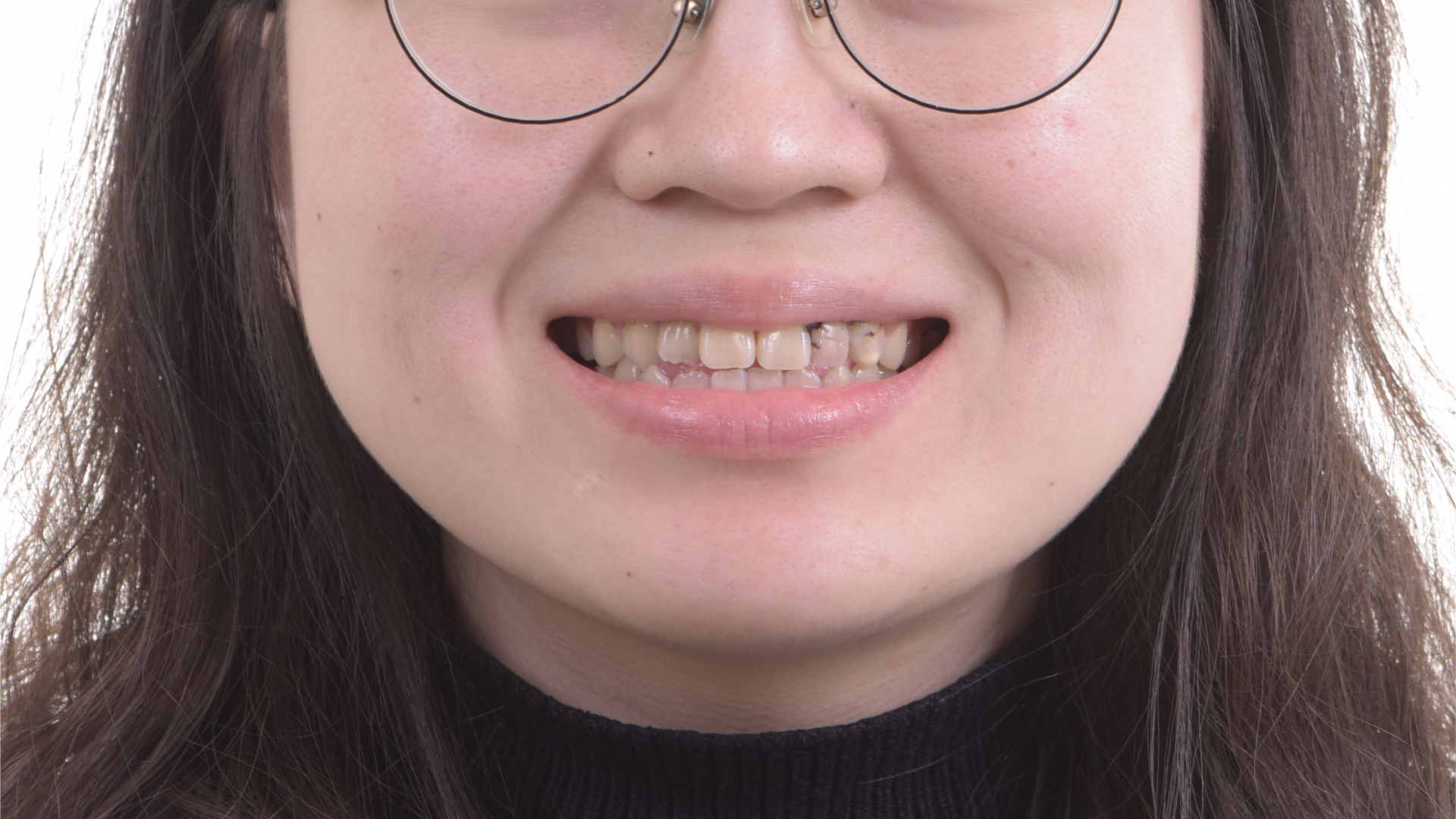 笑起來的時候看到牙齒黑黑的