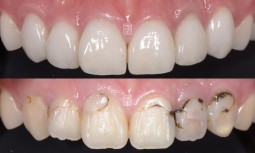 牙齒有點黃，而且之前補的蛀牙黑黑的---局部矯正、美白、全瓷貼片、全瓷冠修復