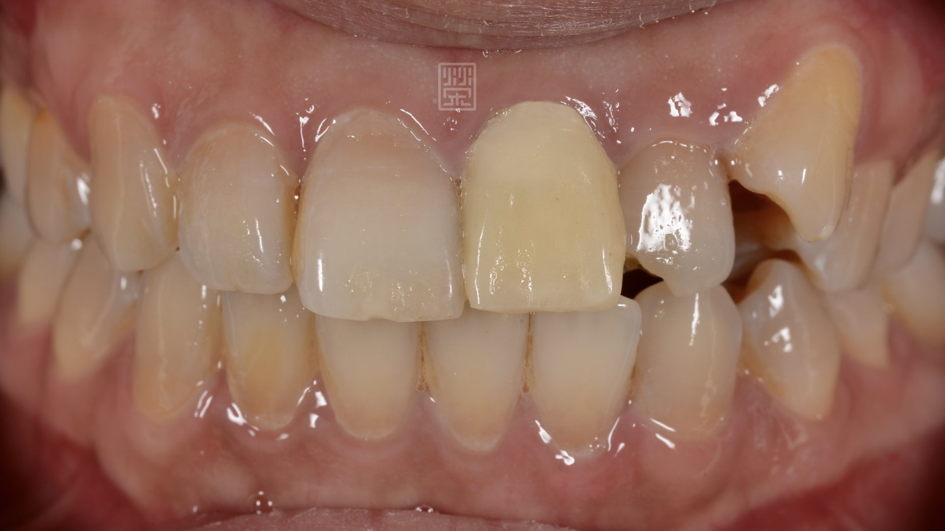 外傷撞斷後，先用臨時假牙恢復