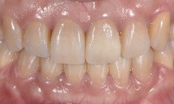 牙齒外傷撞斷，一定要拔掉嗎？——矯正排正牙齒，並且將牙齒拉出後，用纖維釘與全瓷冠修復。