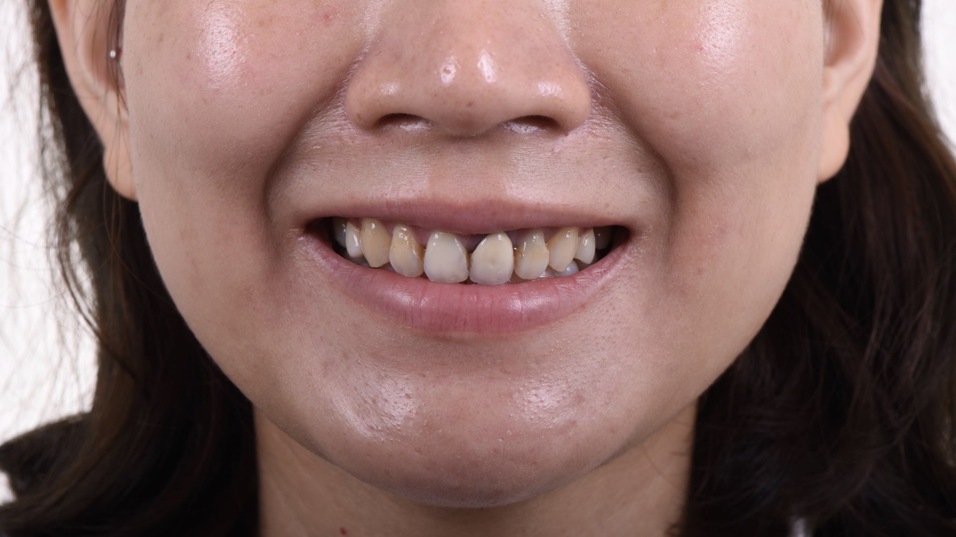 瓷牙冠邊緣變色