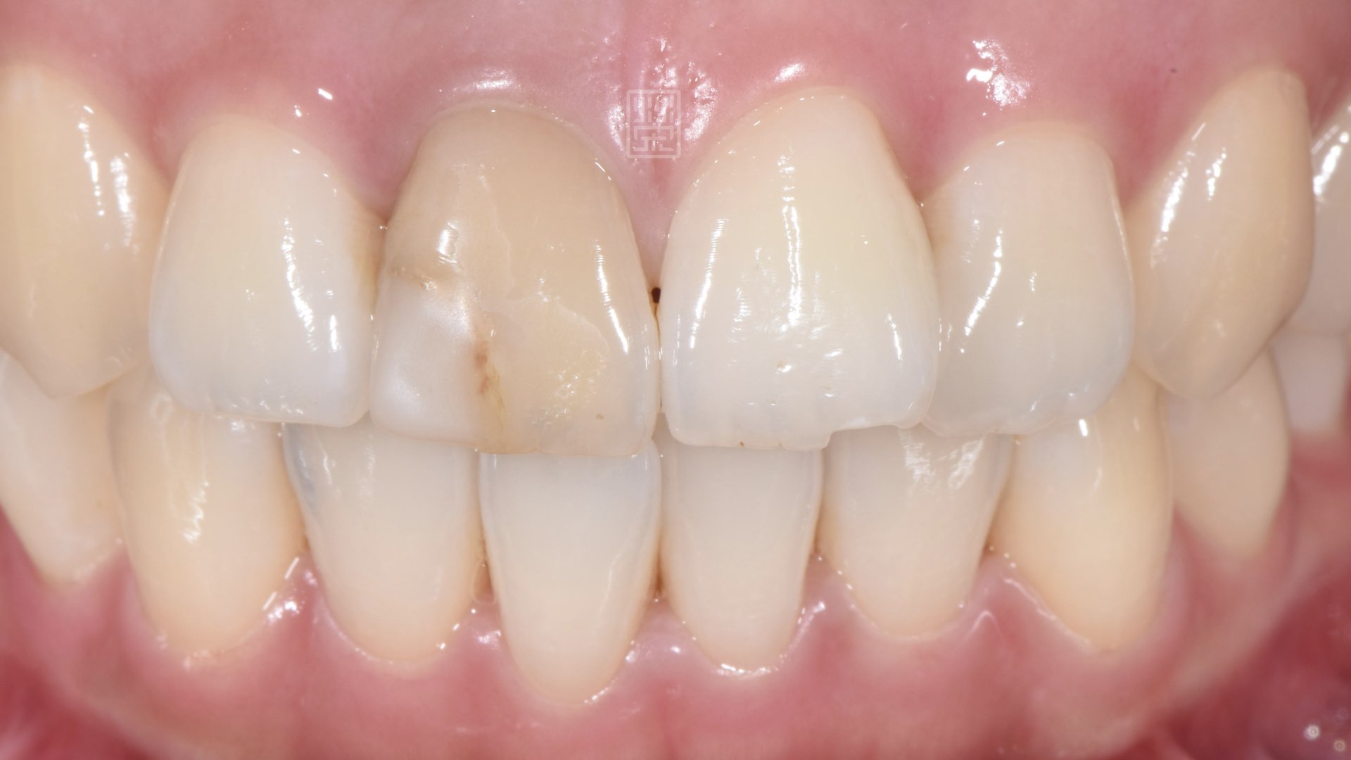 樹脂邊緣變色，與周圍顏色不和諧