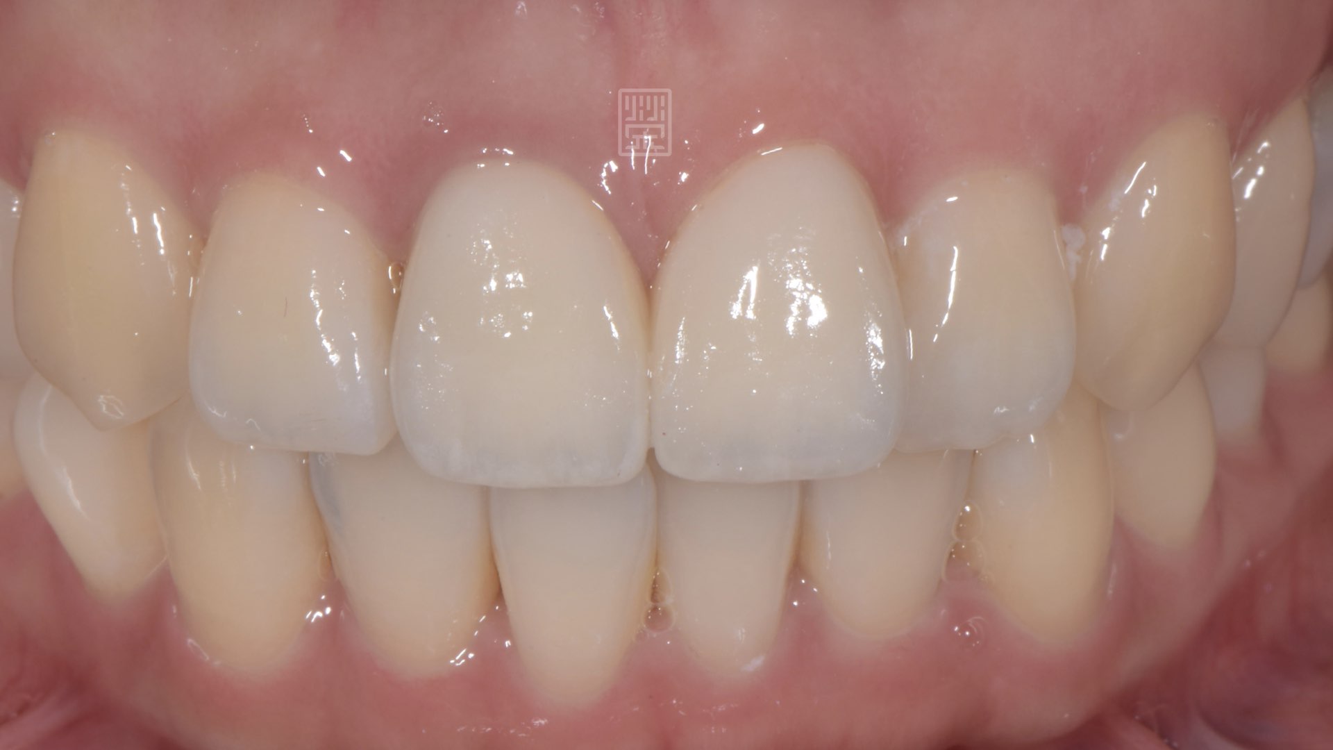雙層全瓷冠與貼片試色