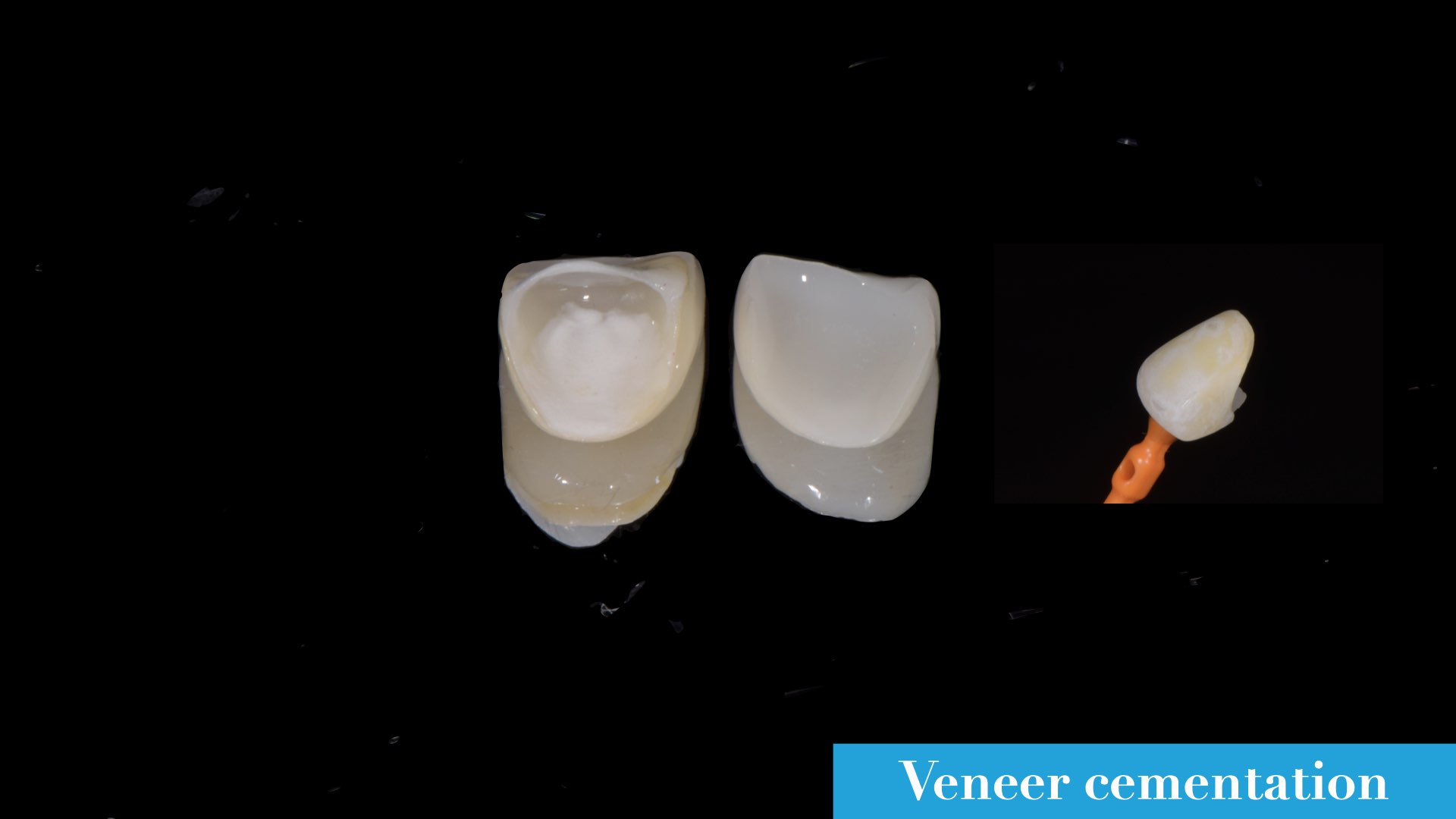 將雙層全瓷冠黏著固定