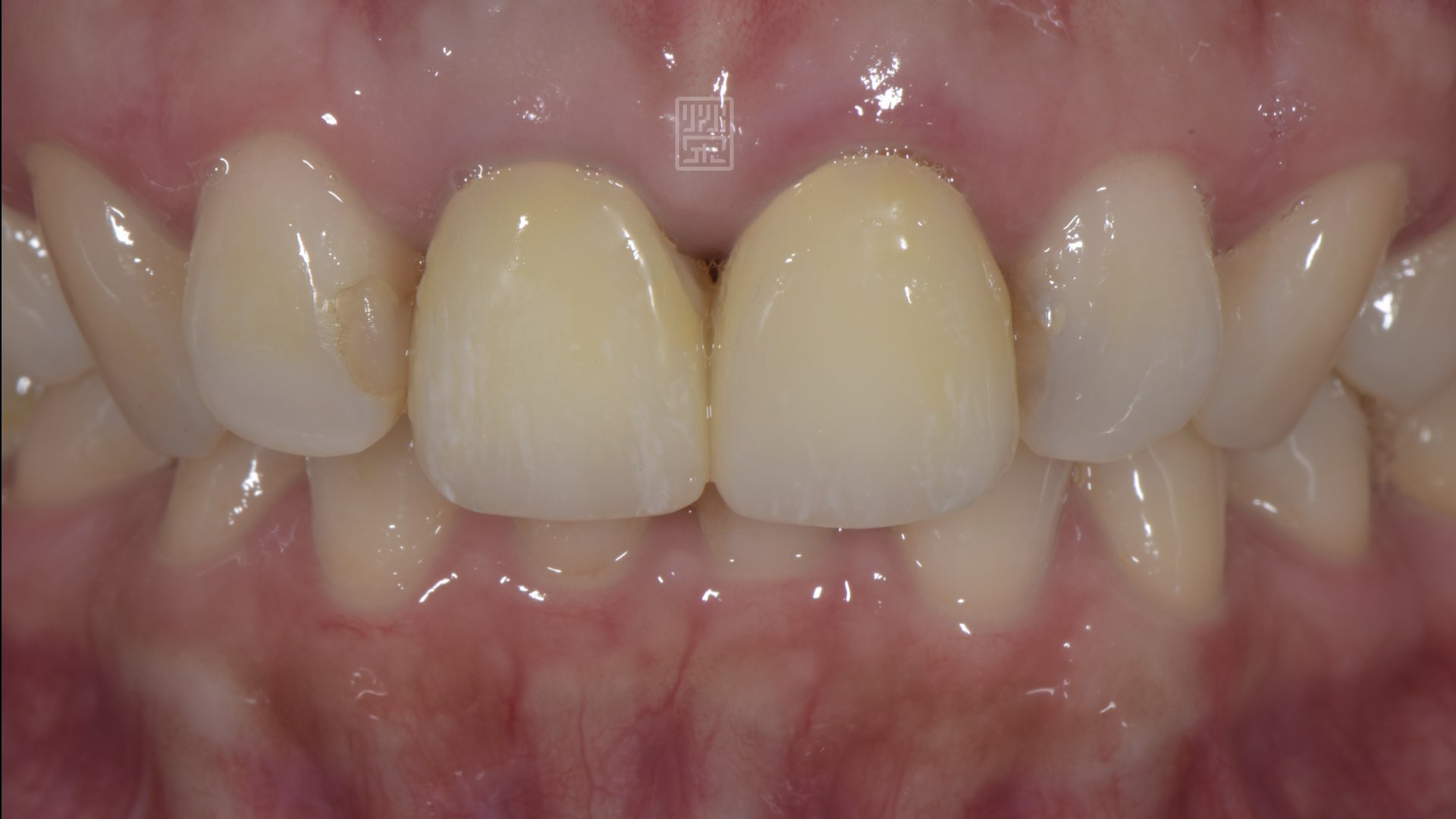 更換成臨時假牙