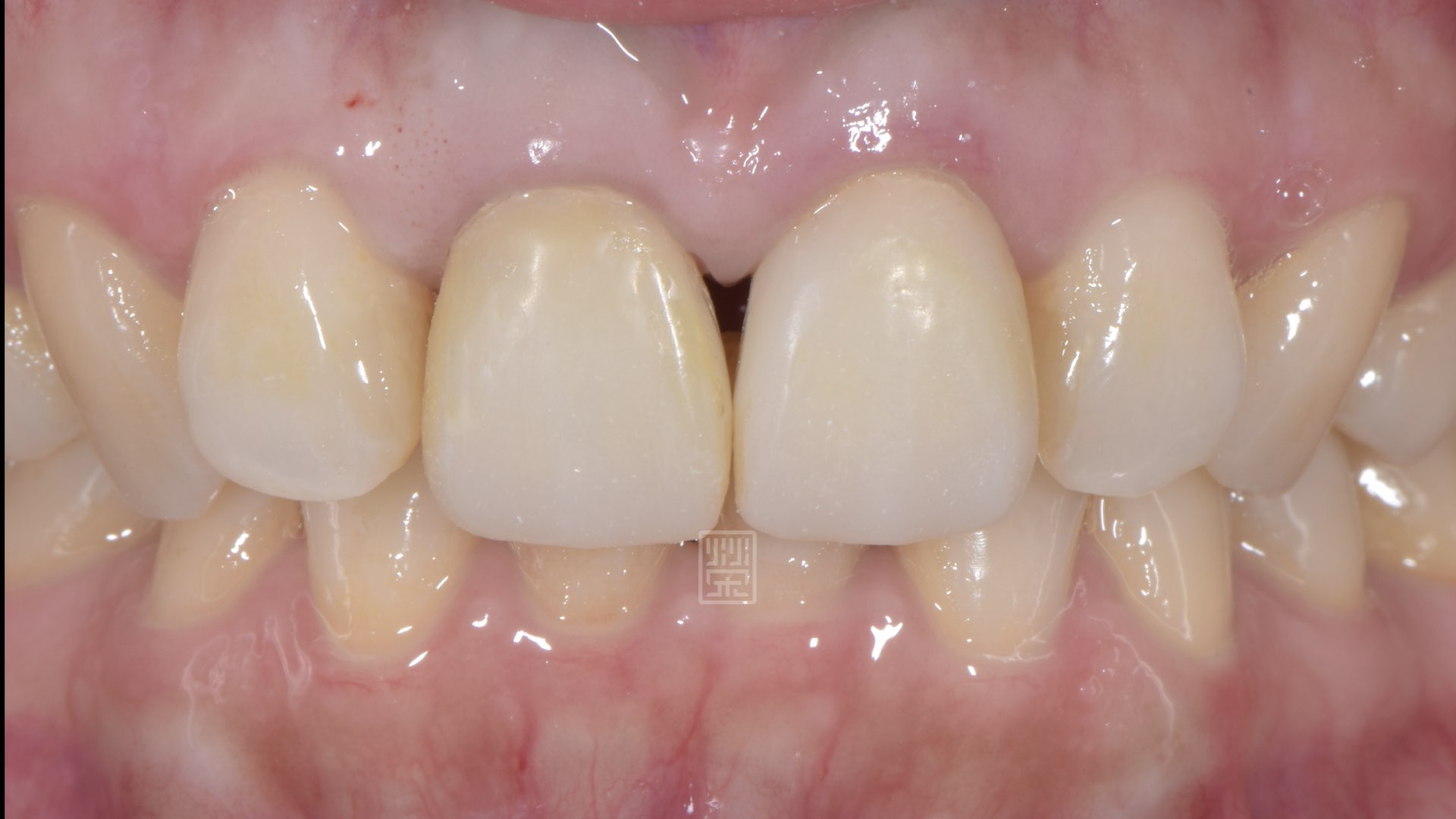 將黑三角縫再打開，以準備牙齦手術填補空間