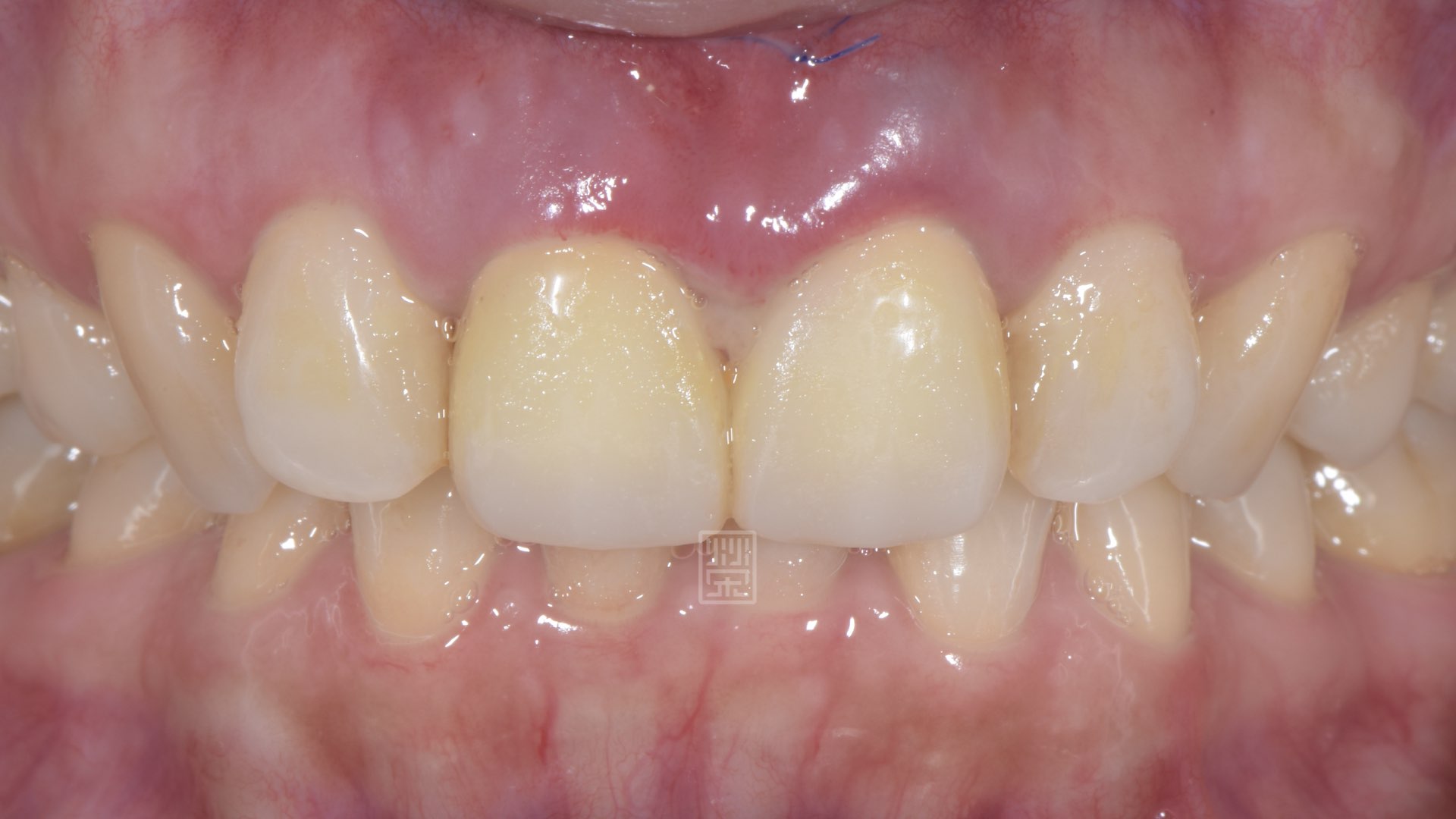 手術後癒合穩定