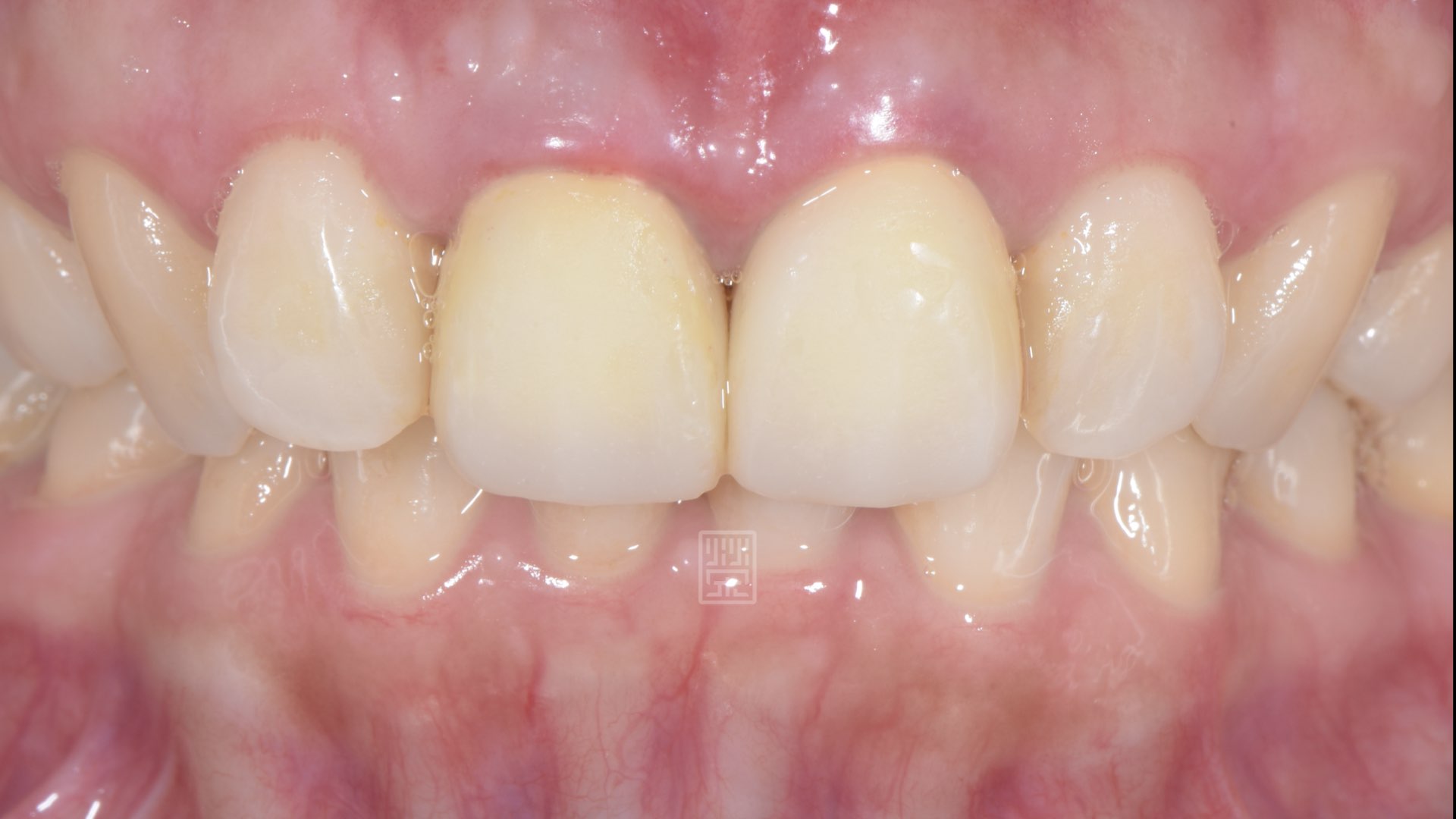 兩週後傷口修復