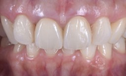 我的全瓷冠裡面破掉了，牙齦處黑黑的————全瓷冠合併牙齦再生手術