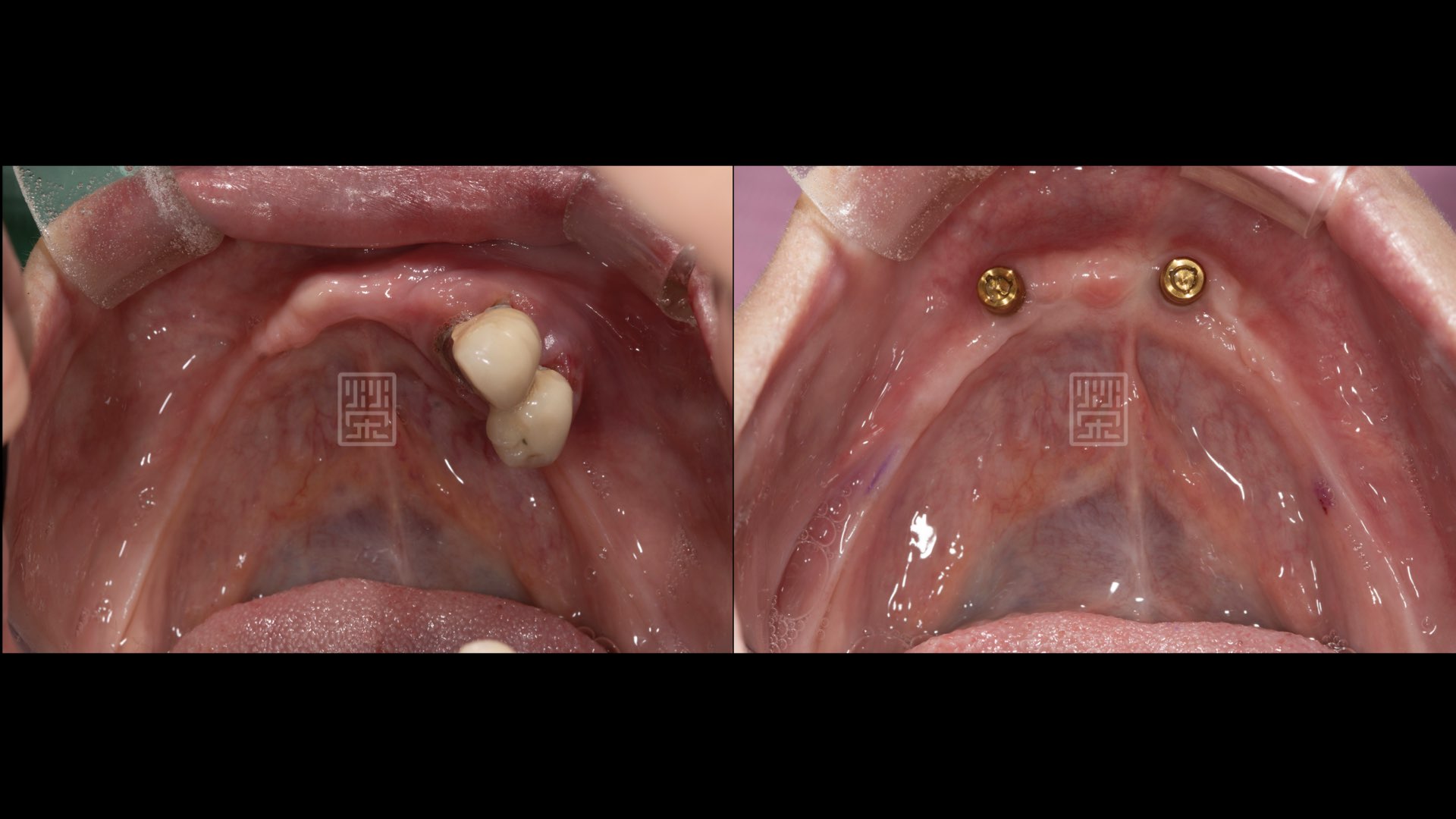 利用兩顆植牙穩定全口義齒