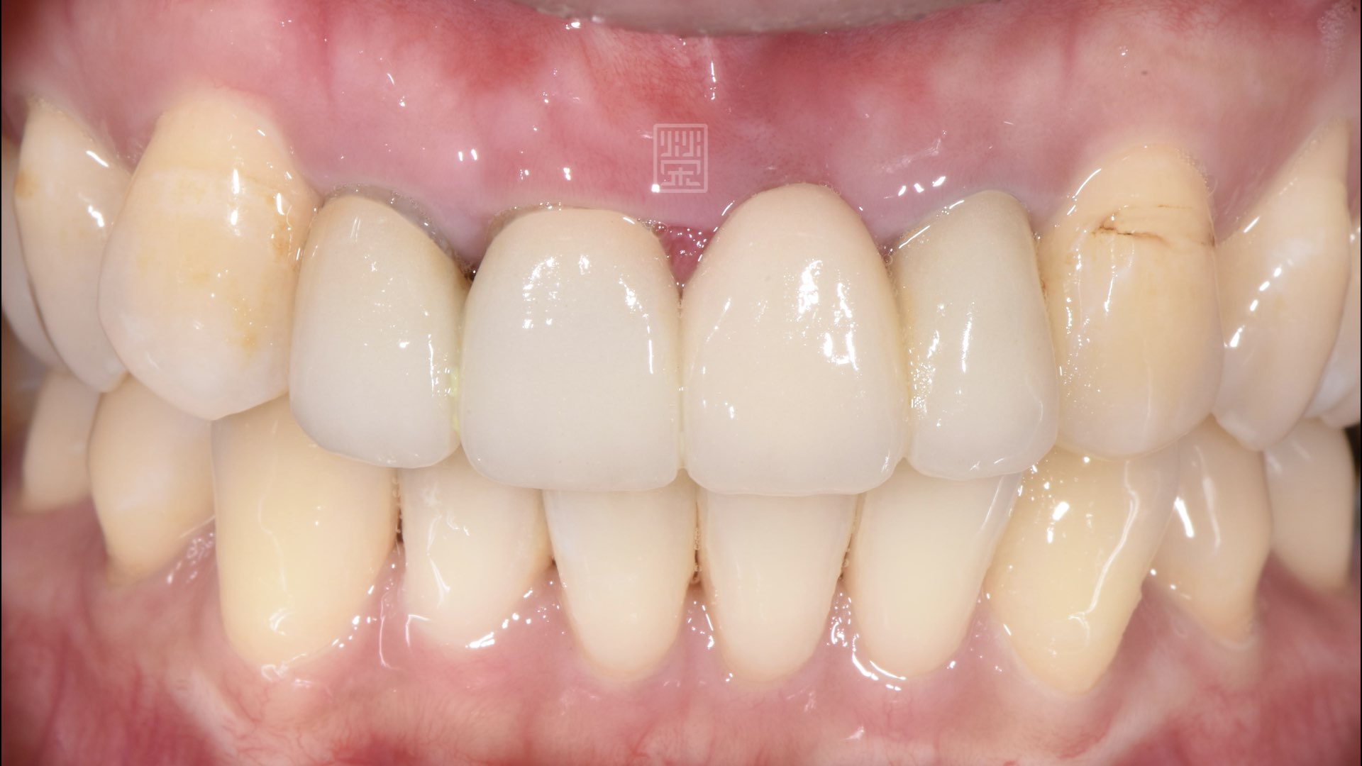 牙齦萎縮，黑邊露出